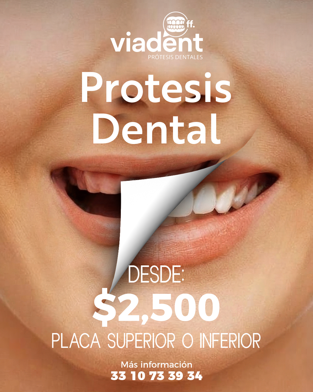 Prótesis Dental antes y después — Laboratorio Guzmán